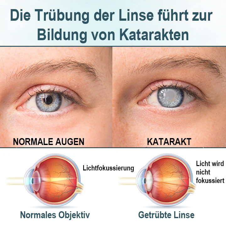 Spzv® OPTIFUSION NANO AUGENTROPFENSER 💧 Nanotechnologie stellt klares Sehen wieder her,  ohne Brille, ohne Operation