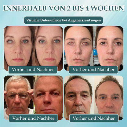 Spzv® OPTIFUSION NANOAUGENTROPFENSERUM🌸 Nanotechnologie stellt klares Sehen wieder her,  ohne Brille, ohne Operation