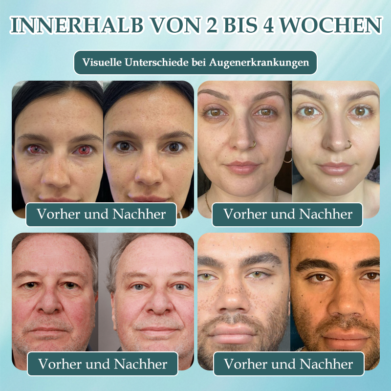Spzv® OPTIFUSION NANOAUGENTROPFENSERUM🌸 Nanotechnologie stellt klares Sehen wieder her,  ohne Brille, ohne Operation