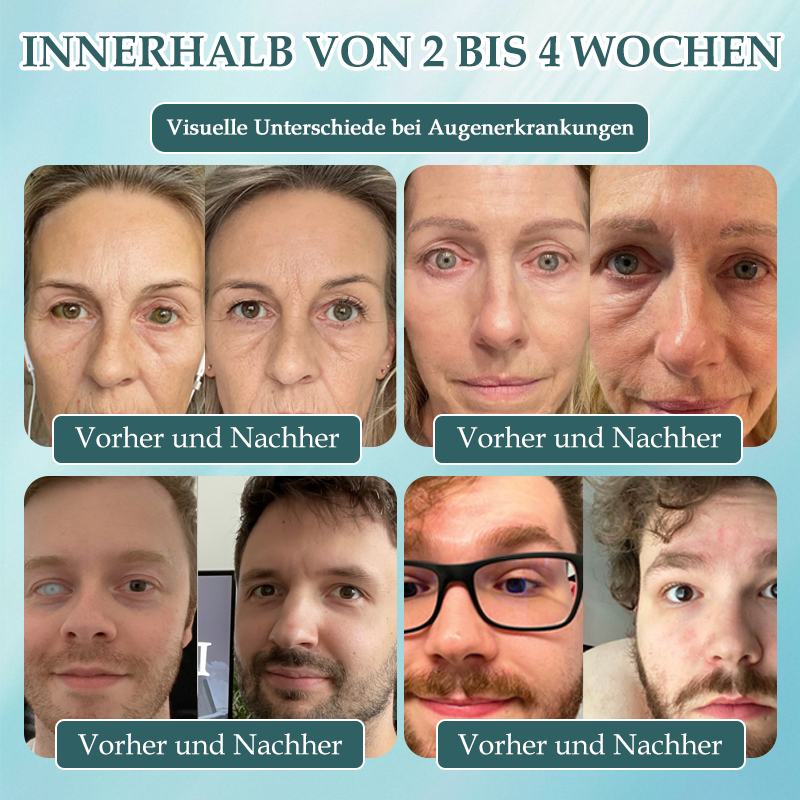 Spzv® OPTIFUSION NANOAUGENTROPFENSERUM🌸 Nanotechnologie stellt klares Sehen wieder her,  ohne Brille, ohne Operation