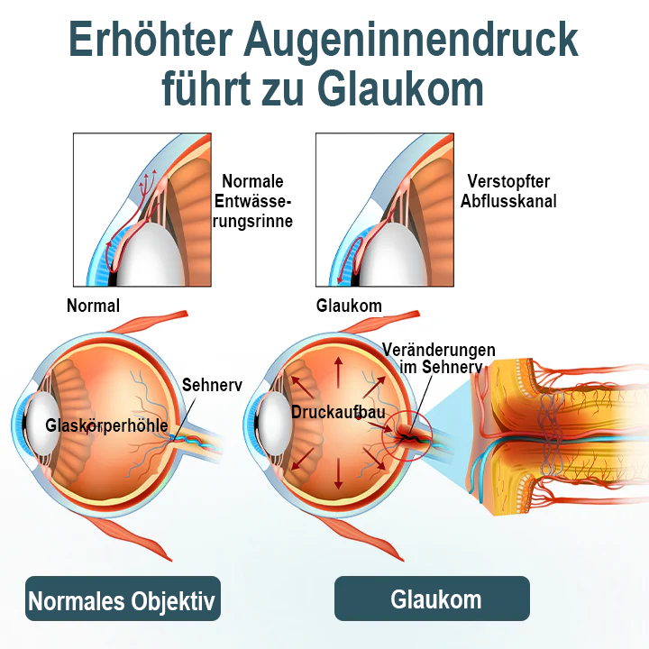 Spzv® OPTIFUSION NANOAUGENTROPFENSERUM🌸 Nanotechnologie stellt klares Sehen wieder her,  ohne Brille, ohne Operation